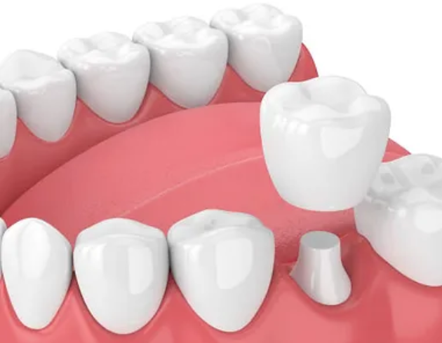 Dental implant diagram showing tooth replacement in gum model with prosthetic tooth restoration.