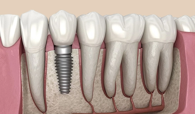 Dental implant model showing natural teeth and titanium implant fixture among tooth replicas.