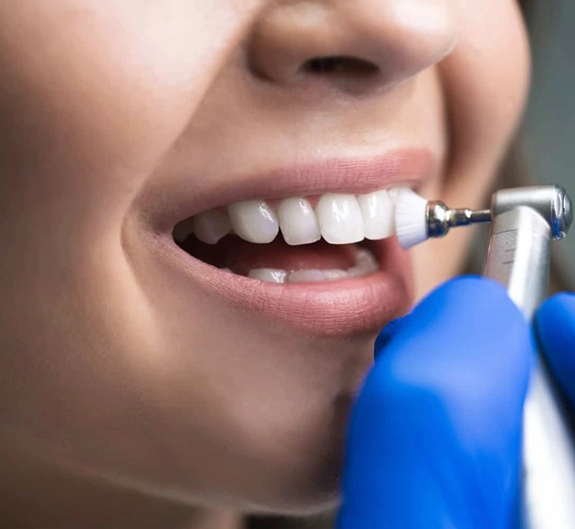 Person receiving professional teeth cleaning with dental polisher tool at dentist office.