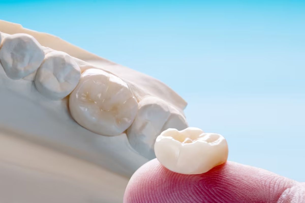 Dental Crowns in New Albany
