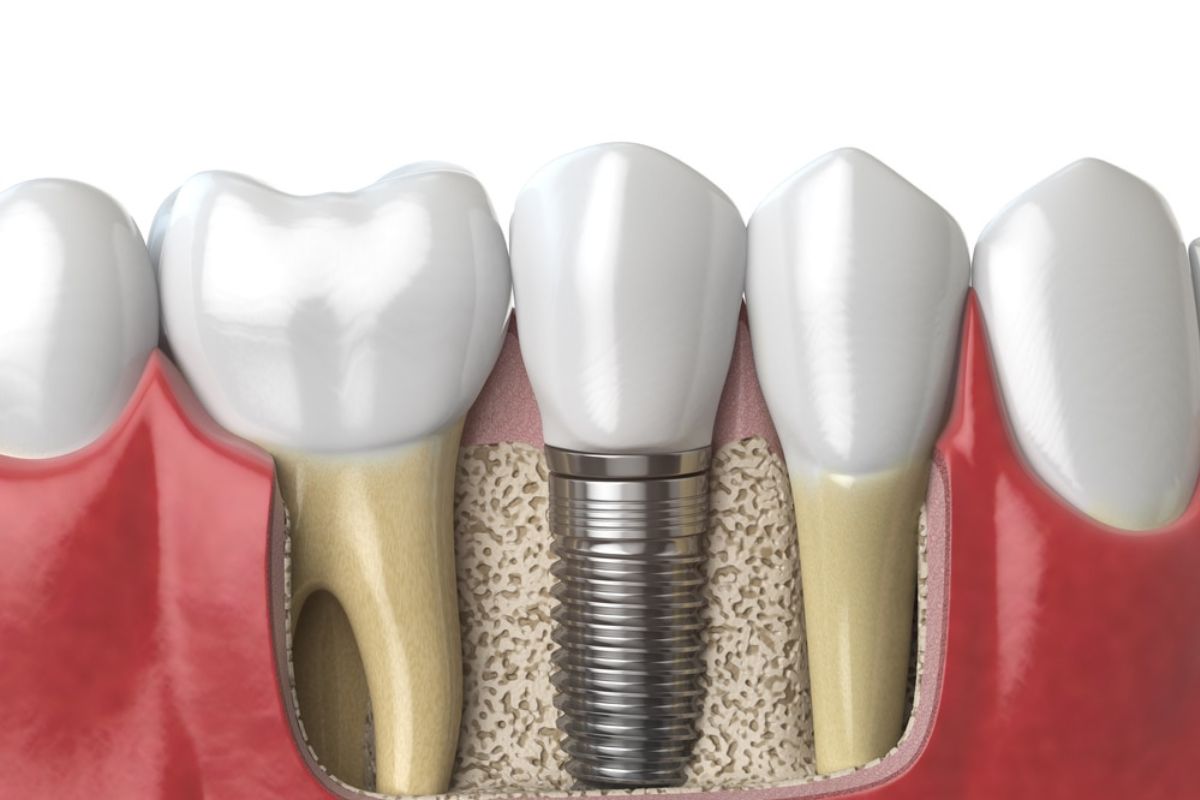 dental implants