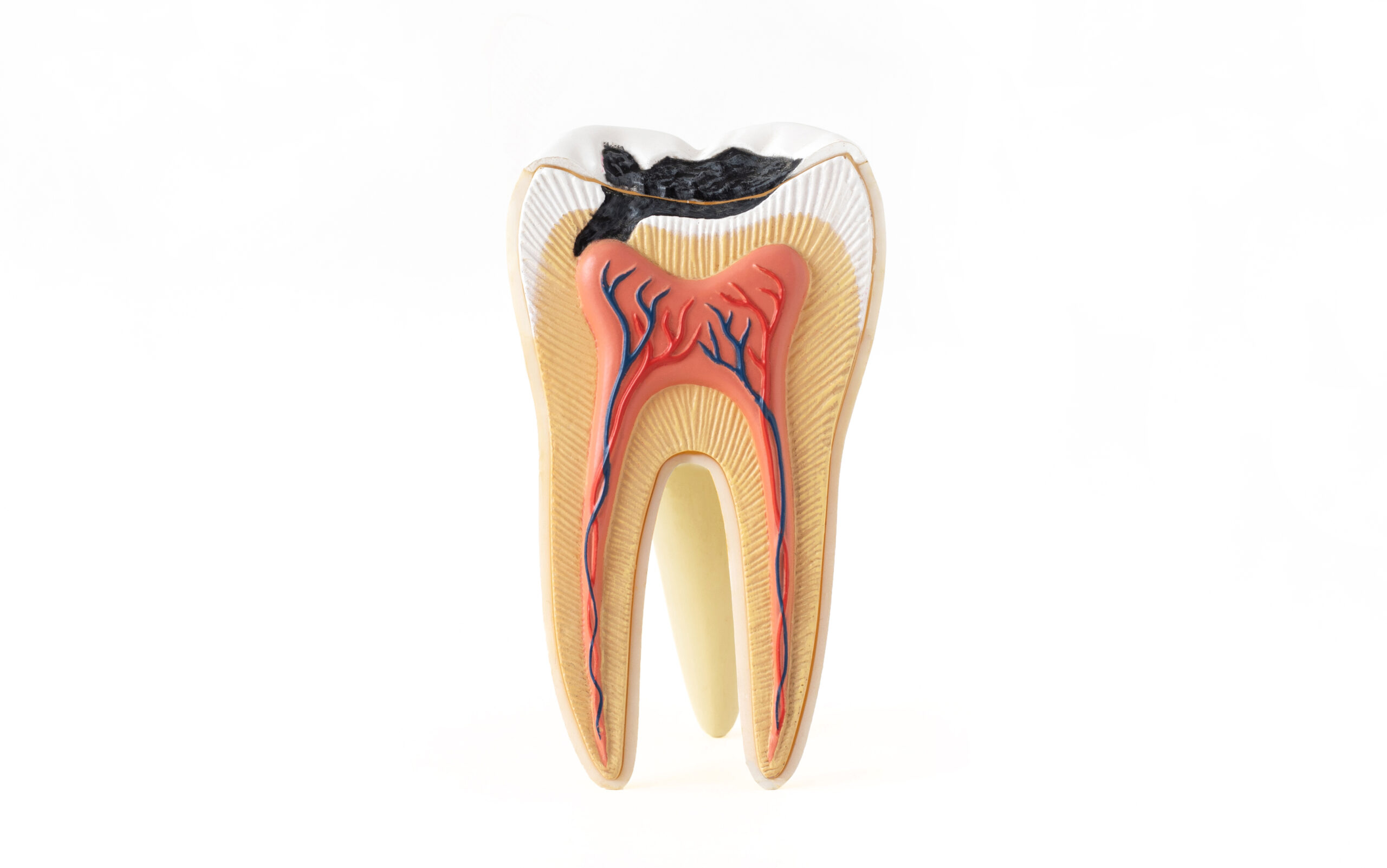 Signs You Might Have a Cavity and What to Do