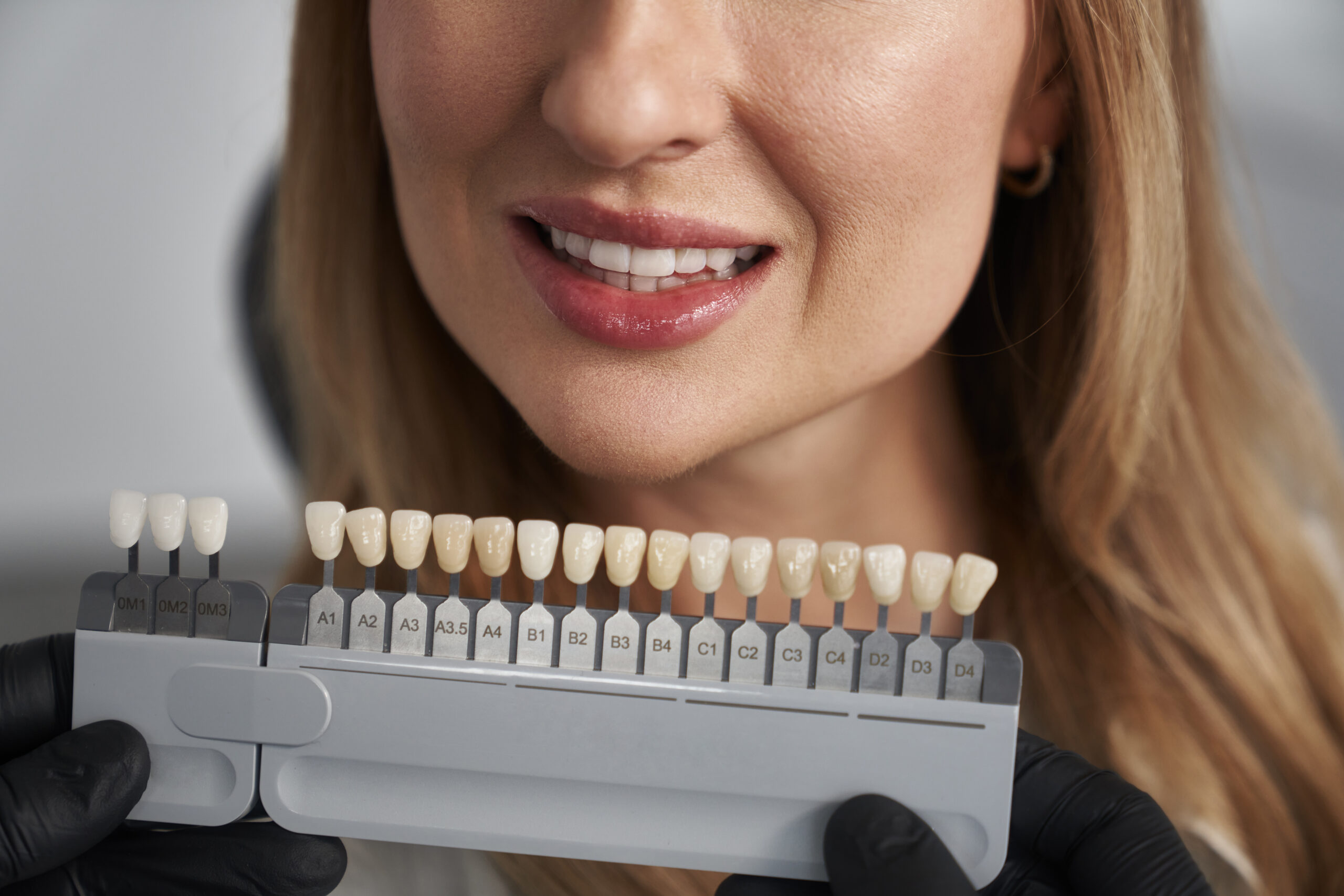 dental veneers
