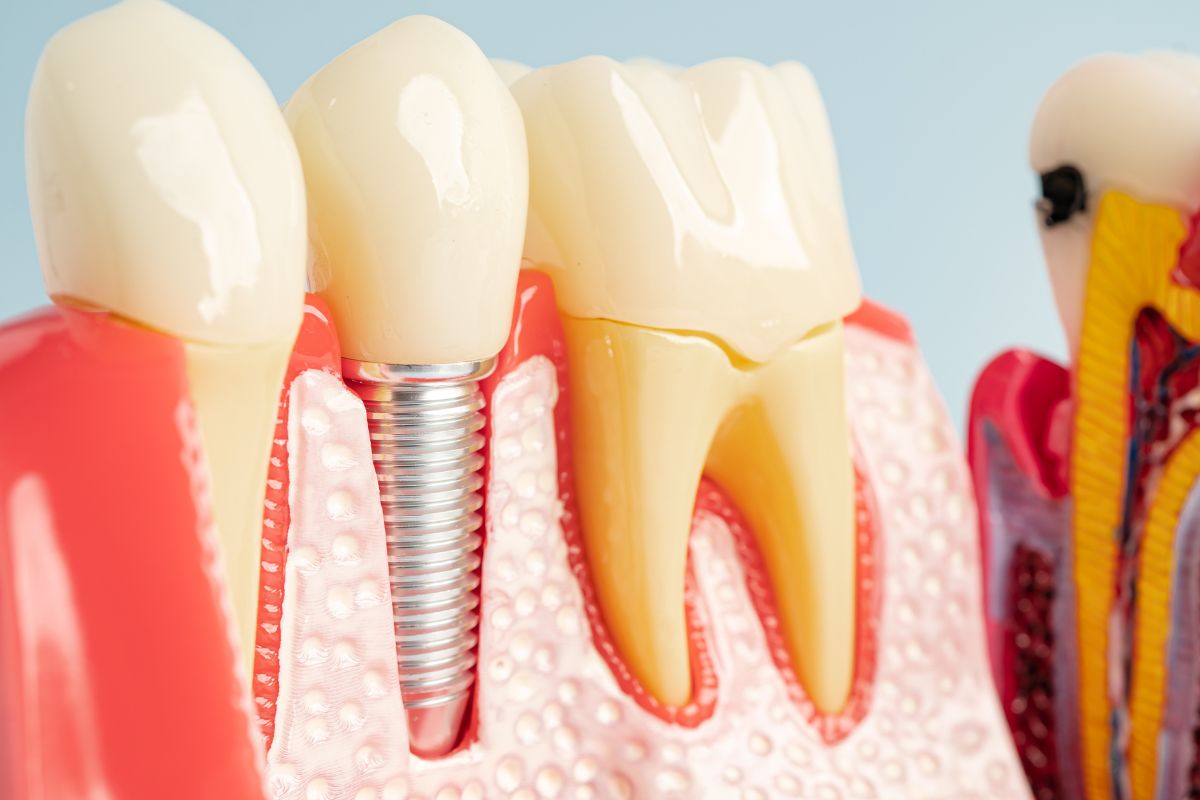 dental implants